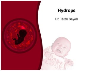 Hydrops
Dr. Tarek Sayed

 