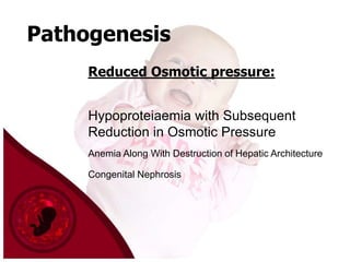 Pathogenesis
Reduced Osmotic pressure:
Hypoproteiaemia with Subsequent
Reduction in Osmotic Pressure
Anemia Along With Destruction of Hepatic Architecture
Congenital Nephrosis

 