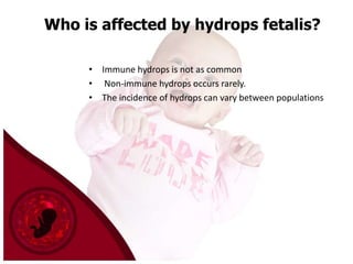 Who is affected by hydrops fetalis?
• Immune hydrops is not as common
• Non-immune hydrops occurs rarely.
• The incidence of hydrops can vary between populations

 