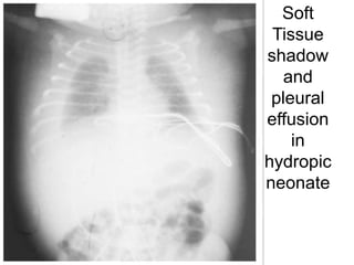 Soft
Tissue
shadow
and
pleural
effusion
in
hydropic
neonate

 