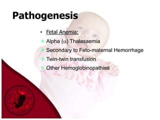 Pathogenesis
• Fetal Anemia:

 Alpha ( ) Thalasaemia
 Secondary to Feto-maternal Hemorrhage
 Twin-twin transfusion
 Other Hemoglobinopathies

 