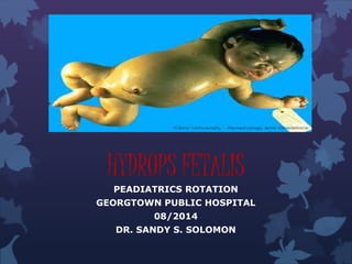 HYDROPS FETALIS 
PEADIATRICS ROTATION 
GEORGTOWN PUBLIC HOSPITAL 
08/2014 
DR. SANDY S. SOLOMON 
 