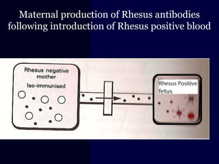 Maternal production of Rhesus antibodies
following introduction of Rhesus positive blood
 