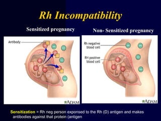 Sensitized pregnancy Non- Sensitized pregnancy
Rh Incompatibility
Sensitization = Rh neg person exponsed to the Rh (D) antigen and makes
antibodies against that protein (antigen).
 