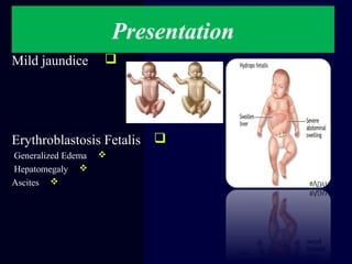Presentation
Mild jaundice
Erythroblastosis Fetalis
Generalized Edema
Hepatomegaly
Ascites
 