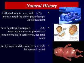 Natural History
•50%of affected infants have mild
anemia, requiring either phototherapy
or no treatment.
•25%have hepatosplenomegaly ,
moderate anemia and progressive
jundice ending in kernicterus, neonatal
death
•25%are hydropic and die in utero or in
the neonatal period
 