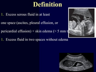 Definition
1. Excess serous fluid in at least
one space (ascites, pleural effusion, or
pericardial effusion) + skin edema (> 5 mm thick)
1. Excess fluid in two spaces without edema
 