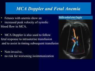MCA Doppler and Fetal Anemia
• Fetuses with anemia show an
• increased peak velocity of systolic
blood flow in MCA.
• MCA Doppler is also used to follow
fetal response to intrauterine transfusion
and to assist in timing subsequent transfusions.
• Non-invasive,
• no risk for worsening isoimmunization
 