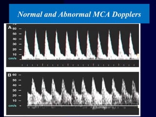 Normal and Abnormal MCA Dopplers
 