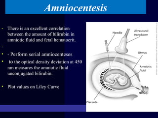 Amniocentesis
- There is an excellent correlation
between the amount of bilirubin in
amniotic fluid and fetal hematocrit.
-
• - Perform serial amniocenteses
• to the optical density deviation at 450
nm measures the amniotic fluid
unconjugated bilirubin.
• Plot values on Liley Curve
at 16 weeks of gestation
 