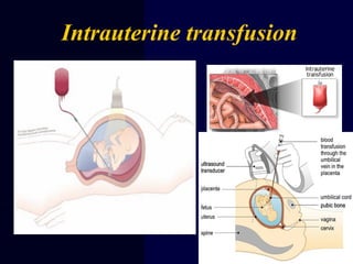 Intrauterine transfusion
 