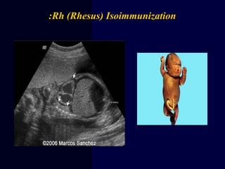 Rh (Rhesus) Isoimmunization:
 