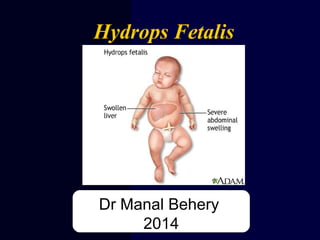 Hydrops Fetalis
Dr Manal Behery
2014
 