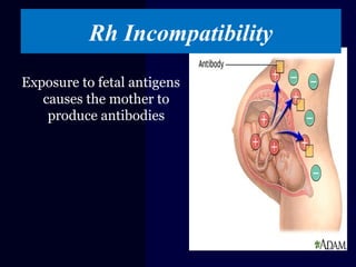 Rh Incompatibility
Exposure to fetal antigens
causes the mother to
produce antibodies
 