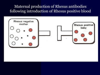 Maternal production of Rhesus antibodies
following introduction of Rhesus positive blood
 
