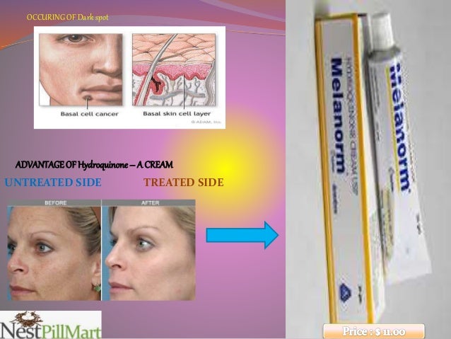 dark spot hydroquinone cream