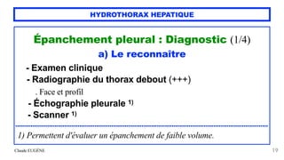 Claude EUGÈNE
HYDROTHORAX HEPATIQUE
Épanchement pleural : Diagnostic (1/4)


a) Le reconnaître


- Examen clinique


- Rad...