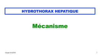 Claude EUGÈNE
HYDROTHORAX HEPATIQUE
Mécanisme


7
 
