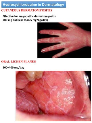 Hydroxychloroquine | PPTX