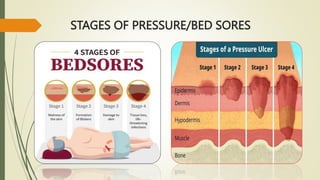 STAGES OF PRESSURE/BED SORES
 