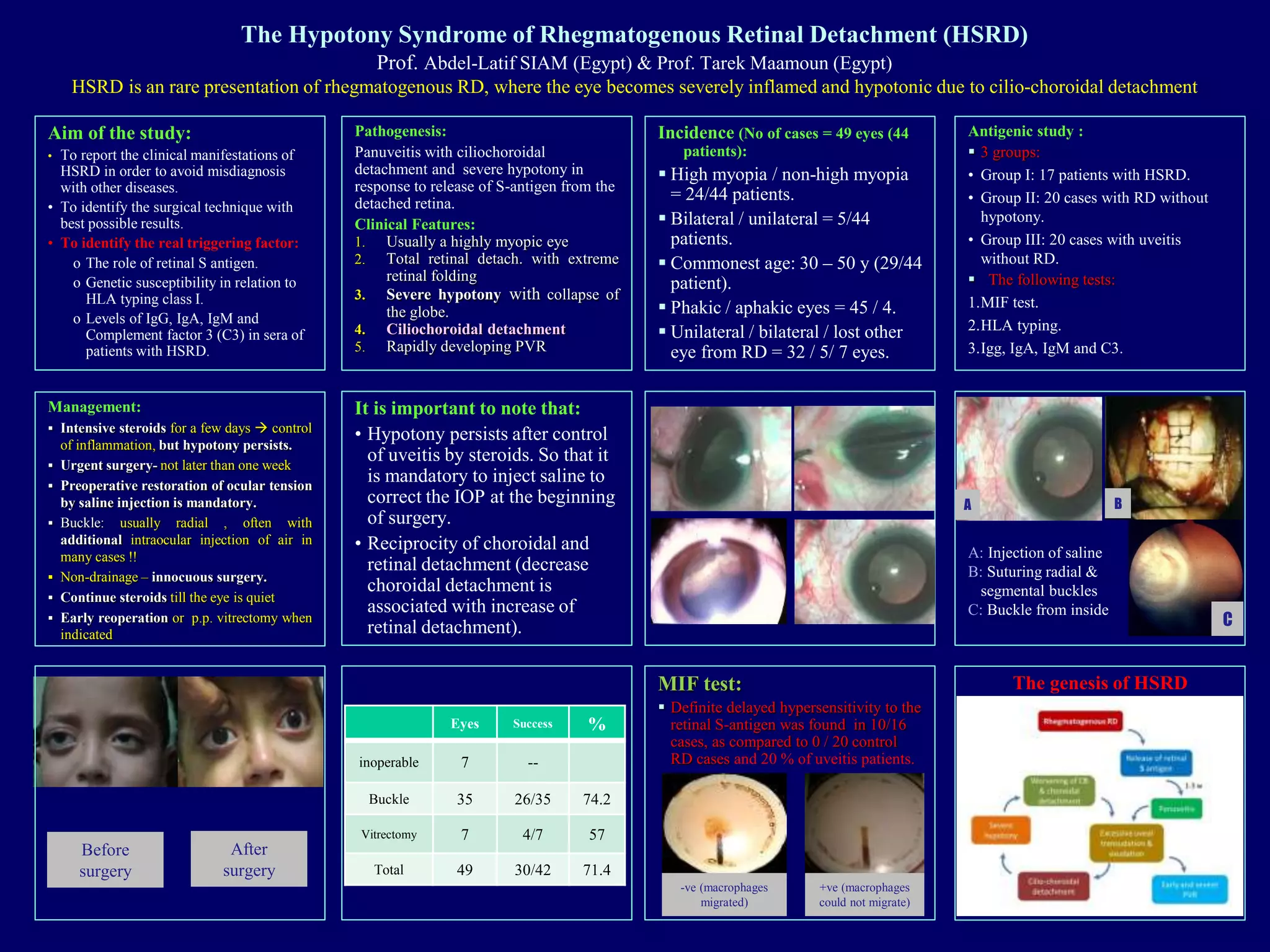 The Hypotony Syndrome of Rhegmatogenous Retinal Detachment | PPT