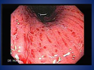 Hyper acidity or acute or chronic gastritis