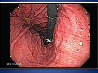 Hyper acidity or acute or chronic gastritis