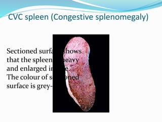 CVC spleen (Congestive splenomegaly)
Sectioned surface shows
that the spleen is heavy
and enlarged in size.
The colour of sectioned
surface is grey-tan.
 