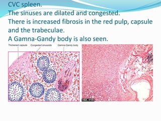 CVC spleen.
The sinuses are dilated and congested.
There is increased fibrosis in the red pulp, capsule
and the trabeculae.
A Gamna-Gandy body is also seen.
 