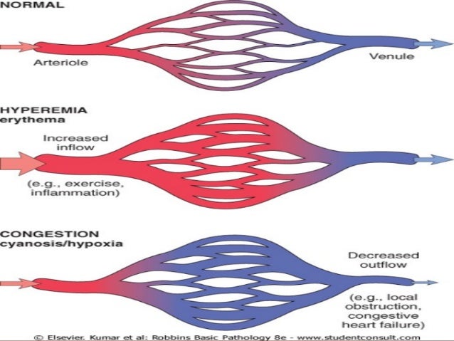 Hyperaemia Congestion And Haemorrhage