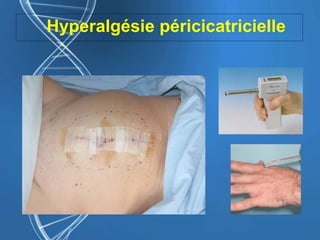 Hyperalgésie péricicatricielle
 