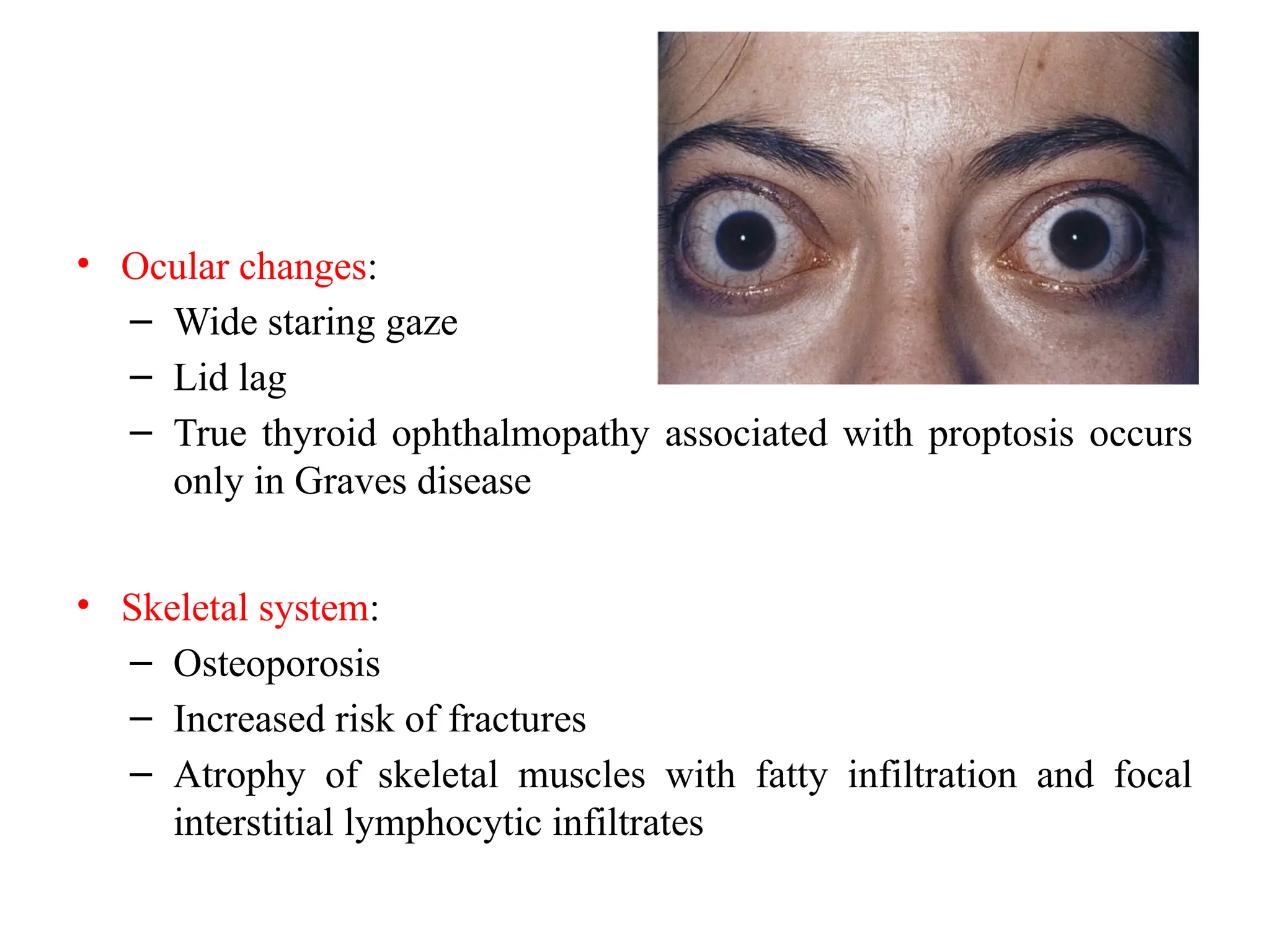 • Ocular changes:
– Wide staring gaze
– Lid lag
– True thyroid ophthalmopathy associated with proptosis occurs
only in Graves disease
• Skeletal system:
– Osteoporosis
– Increased risk of fractures
– Atrophy of skeletal muscles with fatty infiltration and focal
interstitial lymphocytic infiltrates
 