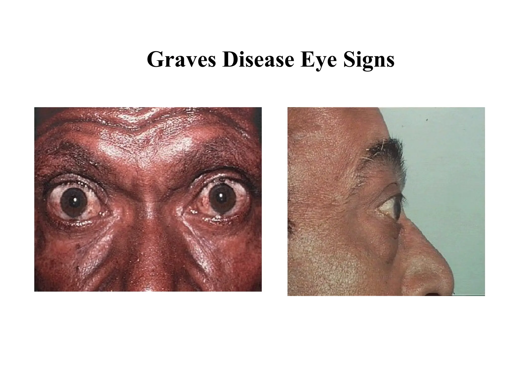 Graves Disease Eye Signs
 