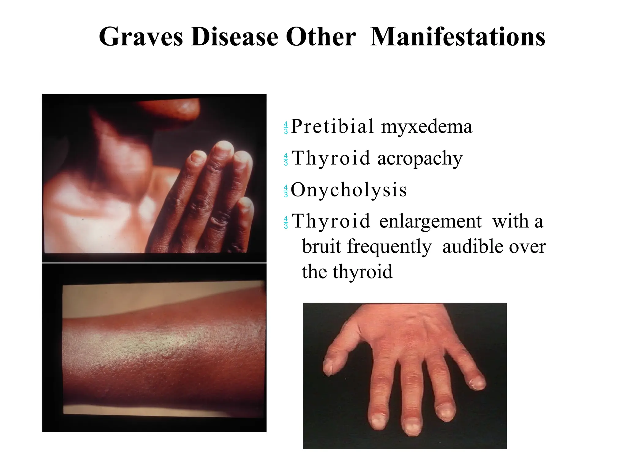 Graves Disease Other Manifestations
 Pretibial myxedema
 Thyroid acropachy
 Onycholysis
 Thyroid enlargement with a
bruit frequently audible over
the thyroid
 