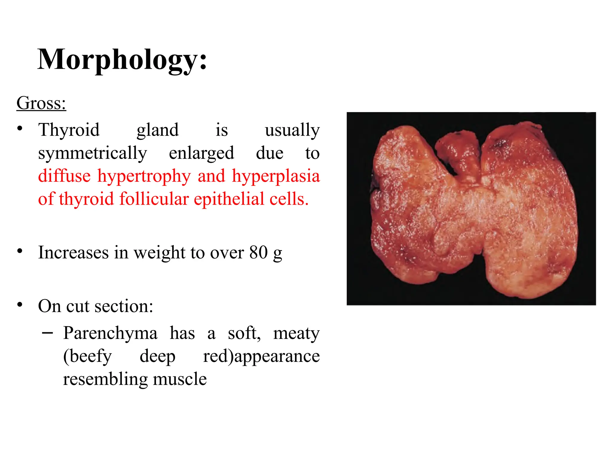 Morphology:
Gross:
• Thyroid gland is usually
symmetrically enlarged due to
diffuse hypertrophy and hyperplasia
of thyroid follicular epithelial cells.
• Increases in weight to over 80 g
• On cut section:
– Parenchyma has a soft, meaty
(beefy deep red)appearance
resembling muscle
 