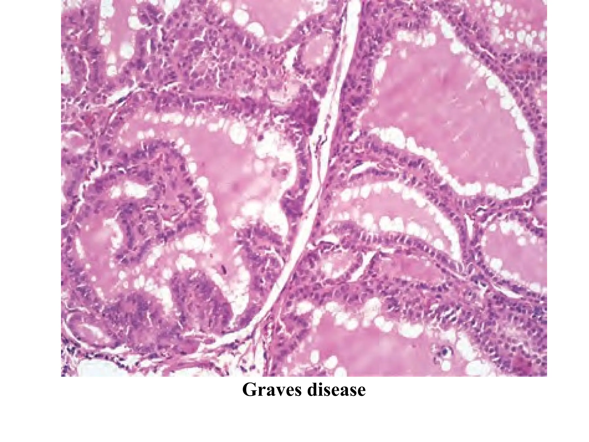 Graves disease
 