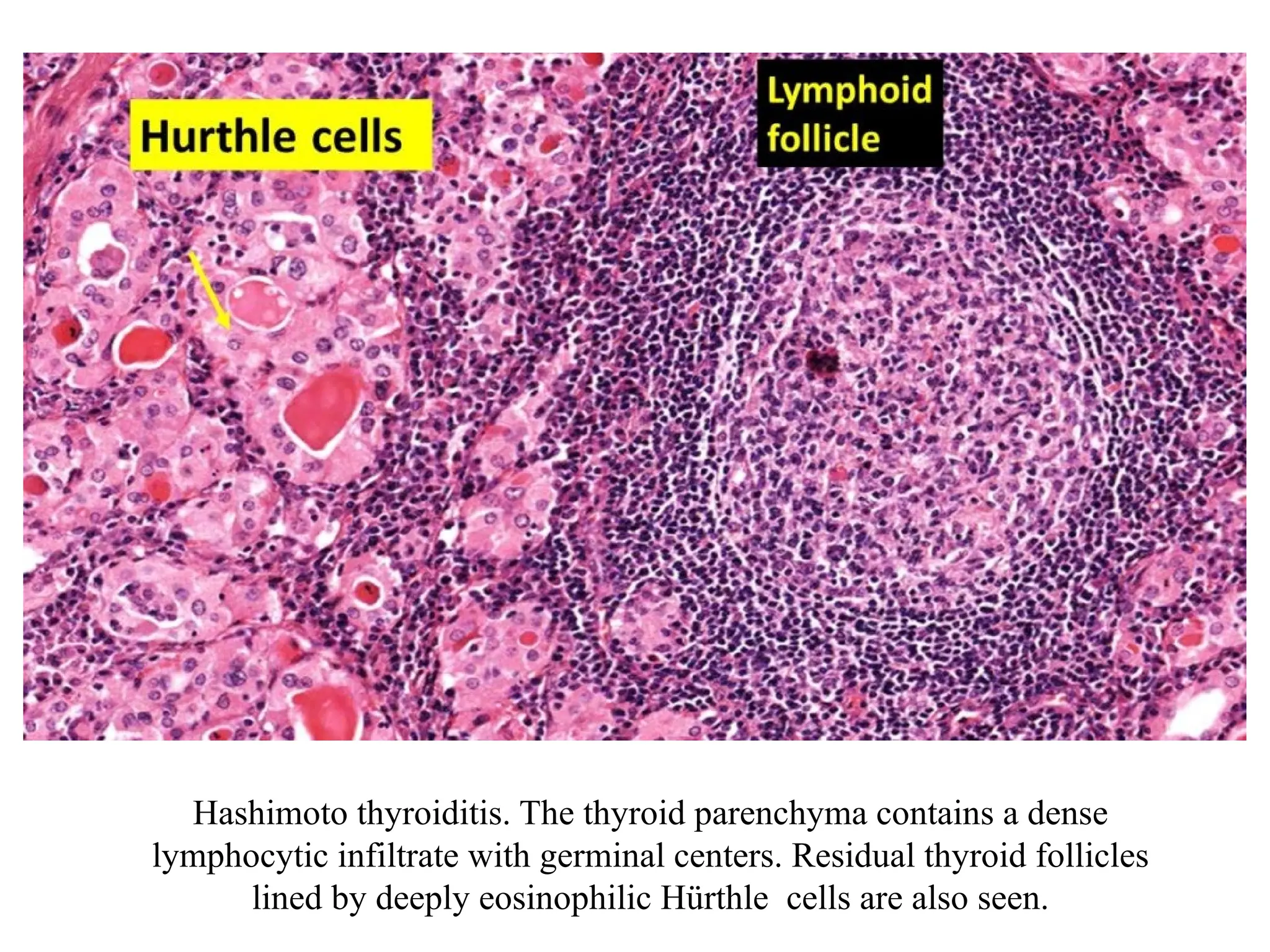 Hashimoto thyroiditis. The thyroid parenchyma contains a dense
lymphocytic infiltrate with germinal centers. Residual thyroid follicles
lined by deeply eosinophilic Hürthle cells are also seen.
 