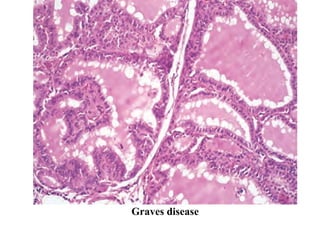 Graves disease
 