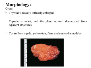 Morphology:
Gross:
• Thyroid is usually diffusely enlarged.
• Capsule is intact, and the gland is well demarcated from
adjacent structures.
• Cut surface is pale, yellow-tan, firm, and somewhat nodular.
 