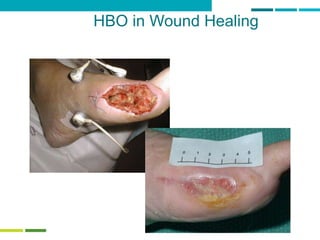 38
HBO in Wound Healing
 