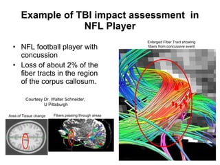 Example of TBI impact assessment  in NFL Player NFL football player with concussion  Loss of about 2% of the fiber tracts in the region of the corpus callosum.  Enlarged Fiber Tract showing fibers from concussive event Courtesy Dr. Walter Schneider,  U Pittsburgh Area of Tissue change Fibers passing through areas 
