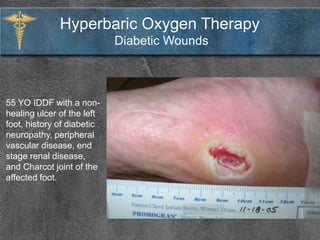 • Hearing loss of at least 30dB
occurring over the course of
three days
• About 20 cases per 100,000
annually in the US
• Cause is unknown
• Treatment is most effective
when given within two weeks
of onset
Newest indication, recognized by most private insurances
Hyperbaric Oxygen Therapy
Sudden Ideopathic Hearing Loss
 