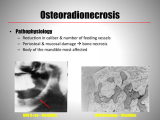 Osteoradionecrosis
• Pathophysiology
– Reduction in caliber & number of feeding vessels
– Periosteal & mucosal damage  bone necrosis
– Body of the mandible most affected
ORN Histology – MandibleORN X-ray – Mandible
 