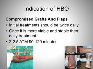 Indication of HBO
Compromised Grafts And Flaps
• Initial treatments should be twice daily
• Once it is more viable and stable then
daily treatment
• 2-2.5 ATM 90-120 minutes
 