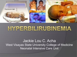 Jackie Lou C. Acha
West Visayas State University College of Medicine
Neonatal Intensive Care Unit
 