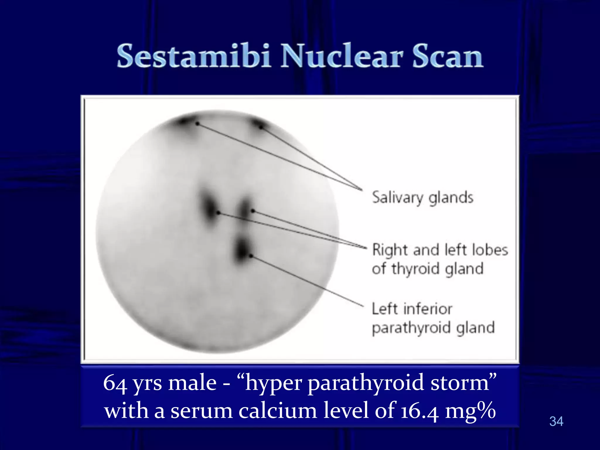 34
64 yrs male - “hyper parathyroid storm”
with a serum calcium level of 16.4 mg%
 