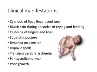 Clinical manifestations:
• Cyanosis of lips , fingers and toes
• Bluish skin during episodes of crying and feeding
• Clubbing of fingers and toes
• Squatting posture
• Dyspnea on exertion
• Hypoxic spells
• Transient cerebral ischemia
• Pan systolic murmur
• Poor growth
 