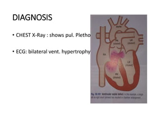 DIAGNOSIS
• CHEST X-Ray : shows pul. Plethora
• ECG: bilateral vent. hypertrophy
 