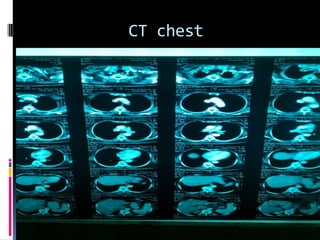 CT chest
 