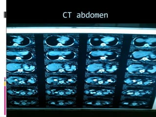 CT abdomen
 